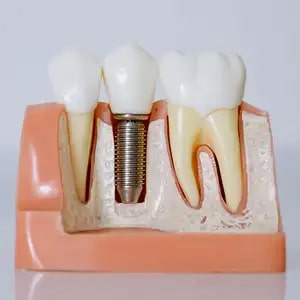 Advantages of Dental Implants | Implant Dentist Los Gatos