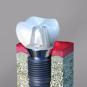 Choosing the Best Dental Implant Types for You