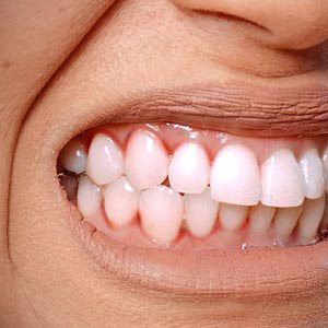 Gum Disease's Impact on Cosmetic Dentistry
