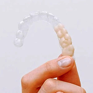 How Does Invisalign Fix Open Bite? | Los Gatos