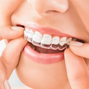 How Does Invisalign Works? | Los Gatos, CA