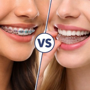 Invisalign in Los Gatos vs Braces comparison showing a smile with metal braces on one side and a clear aligner on the other.