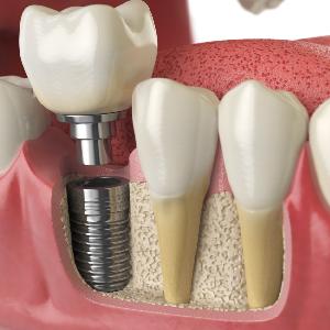Top 6 Aftercare Tips From an Implant Dentist in Los Gatos