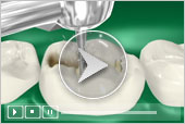 Tooth Colored Fillings - Class I