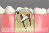 sealants