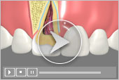 sealants