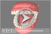 Immediate Dentures