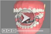 Partial Dentures