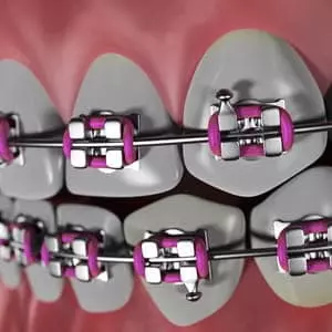 reshaping misaligned teeth