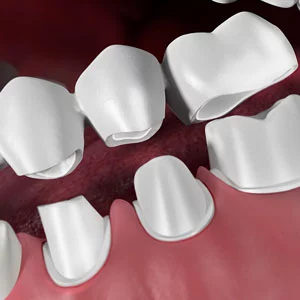 dental bridges