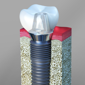 dental implants