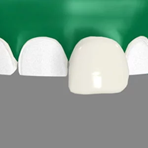 dental veneers