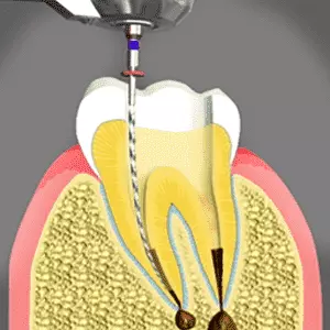 root canal treatment